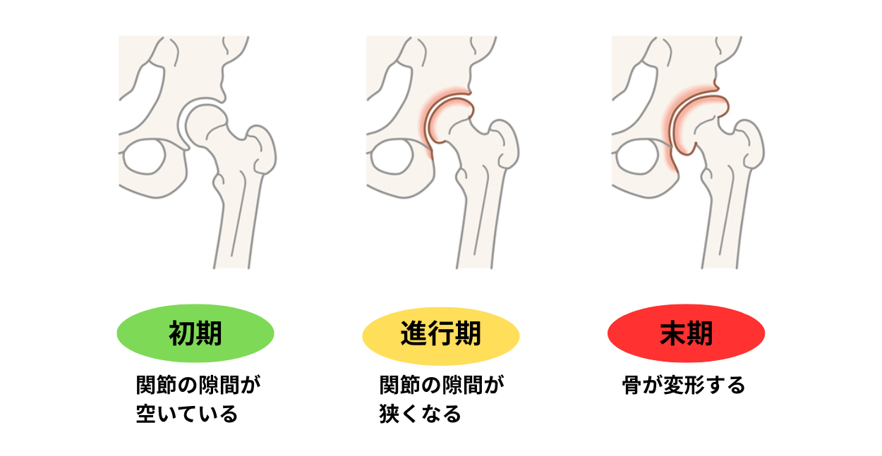 変形性股関節症の図解